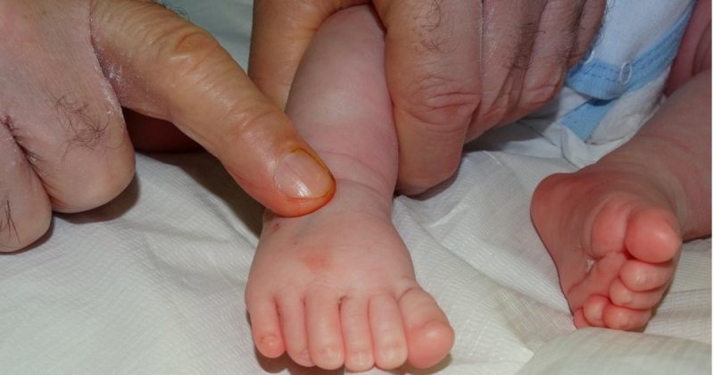 Бебче с шест пръста се роди в бургаска болница, родителите в шок